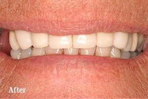 Columbus Top Smile Transformation - Gallery image 5 after